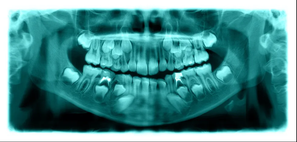 Panoramic digital dental X-ray showing developing teeth